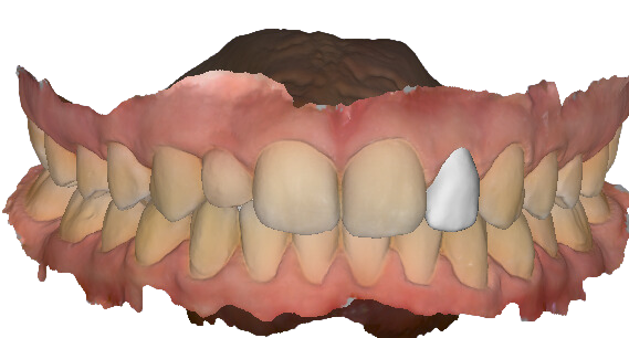 tooth-3D-printing