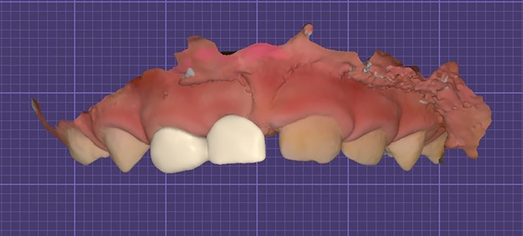 3D Printed Dental Bridge Design in Exocad Software