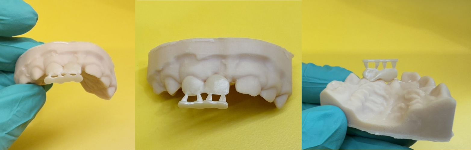 Pediatric Dental Bridge 3D Printed Tooth Design on Model