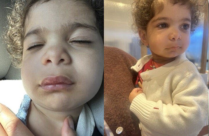 Toddler with Swollen Upper Lip Due to Pediatric Tooth Trauma