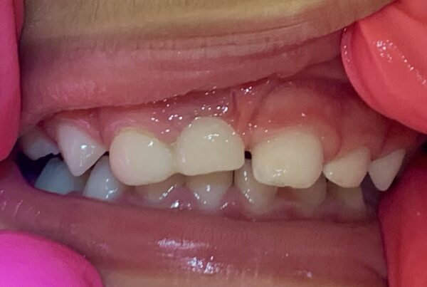 Two Months Post-Op Pediatric Dental Bridge Close-Up in Toddler’s Mouth