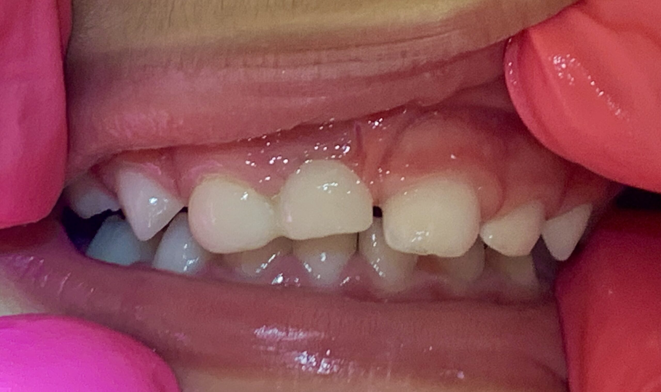 Tiny Smile Big Solution: How 3D Printing Helped Restore a Toddlers Front Tooth
