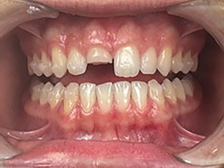 fractured incisor inside mouth