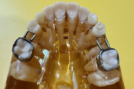 metal-Pediatric Space Maintainer