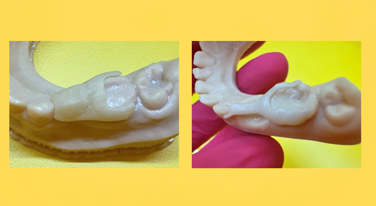 SmileKeeper™Pediatric Space Maintainers