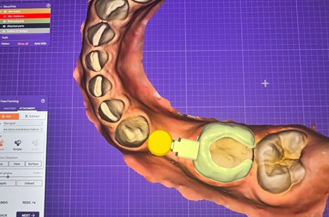 3d-model-Smile-Keepers-Pediatric-Space-Maintainers-3Dprinted-3