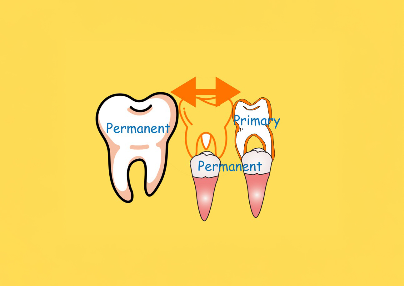 Tooth-Chart-Showing-Where-a-Pediatric Space Maintainer-would-be-placed