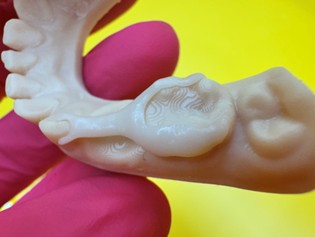 SmileKeeper™: A next-generation, 3D printed, child-friendly space maintainer