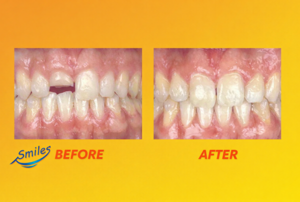 traumatic-tooth-fracture-before-after-dental-restoration