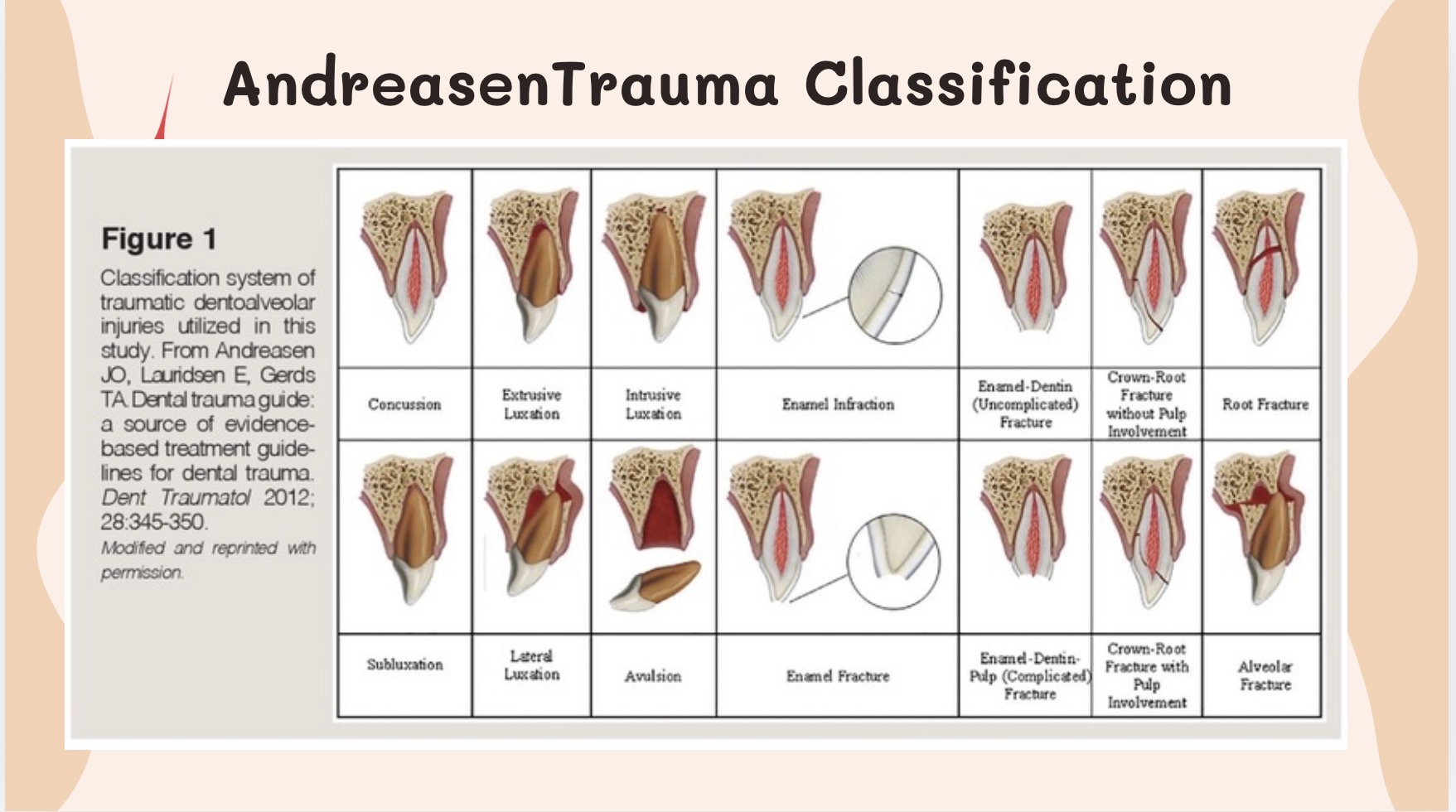 andreasen-dental-trauma-classification-dentoalveolar-injury-diagram