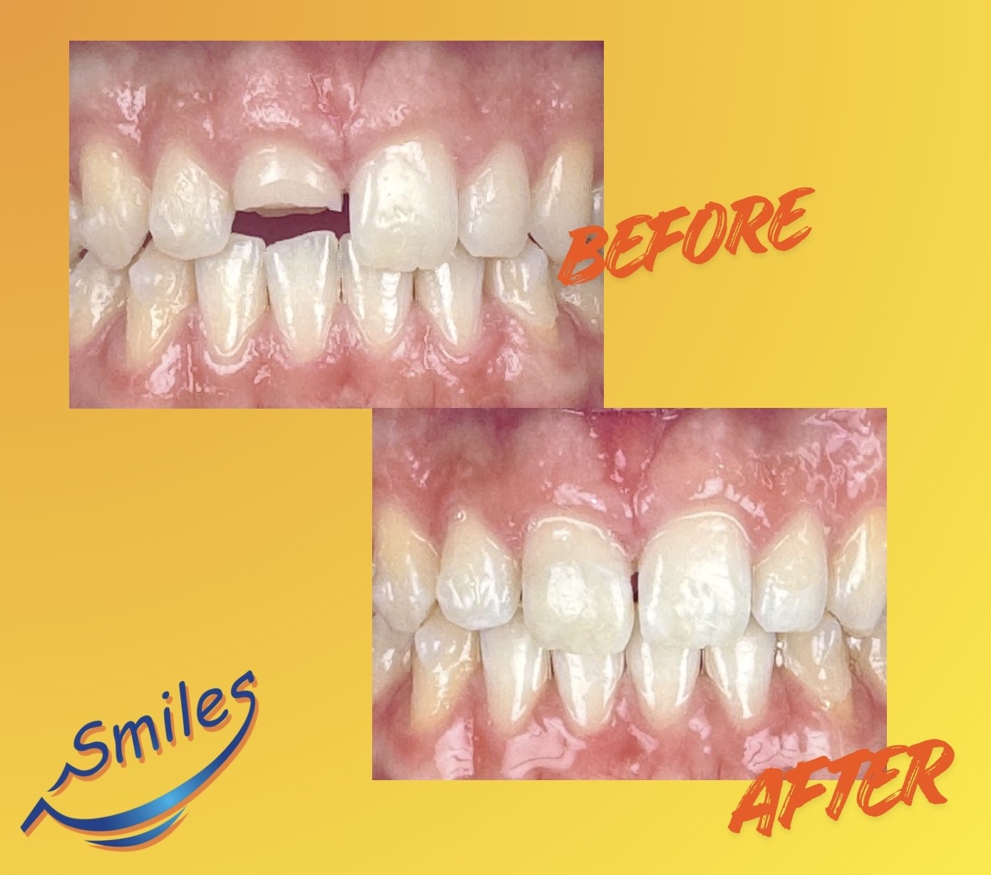dental-trauma-cracked-tooth-before-after-restoration_