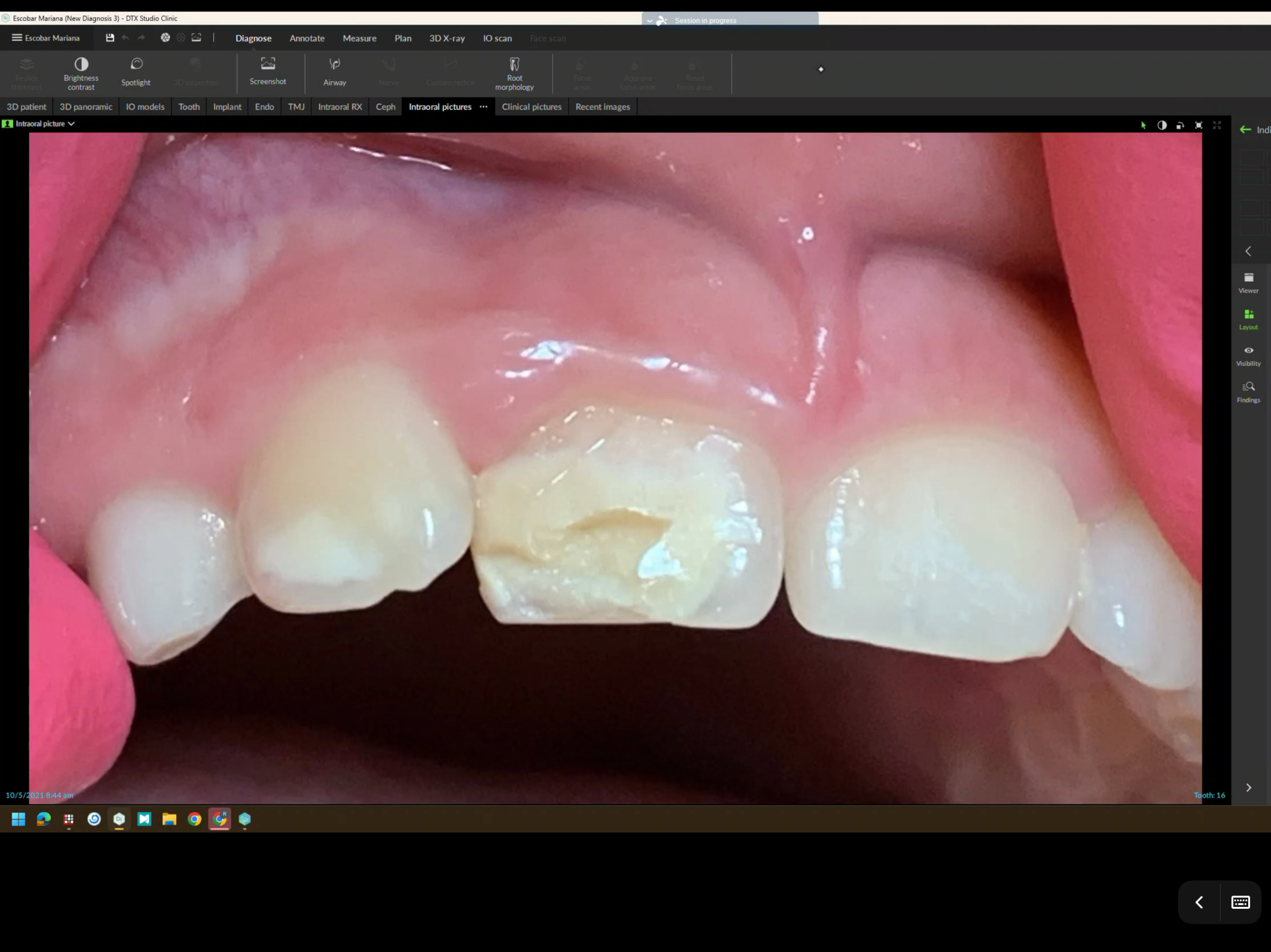 Dental-close-up-pediatric-teeth-restore-