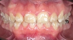 Before Dental-close-up-pediatric-teeth-restore