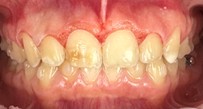 after laser gum recontouring-Dental-close-up-pediatric-teeth-restore