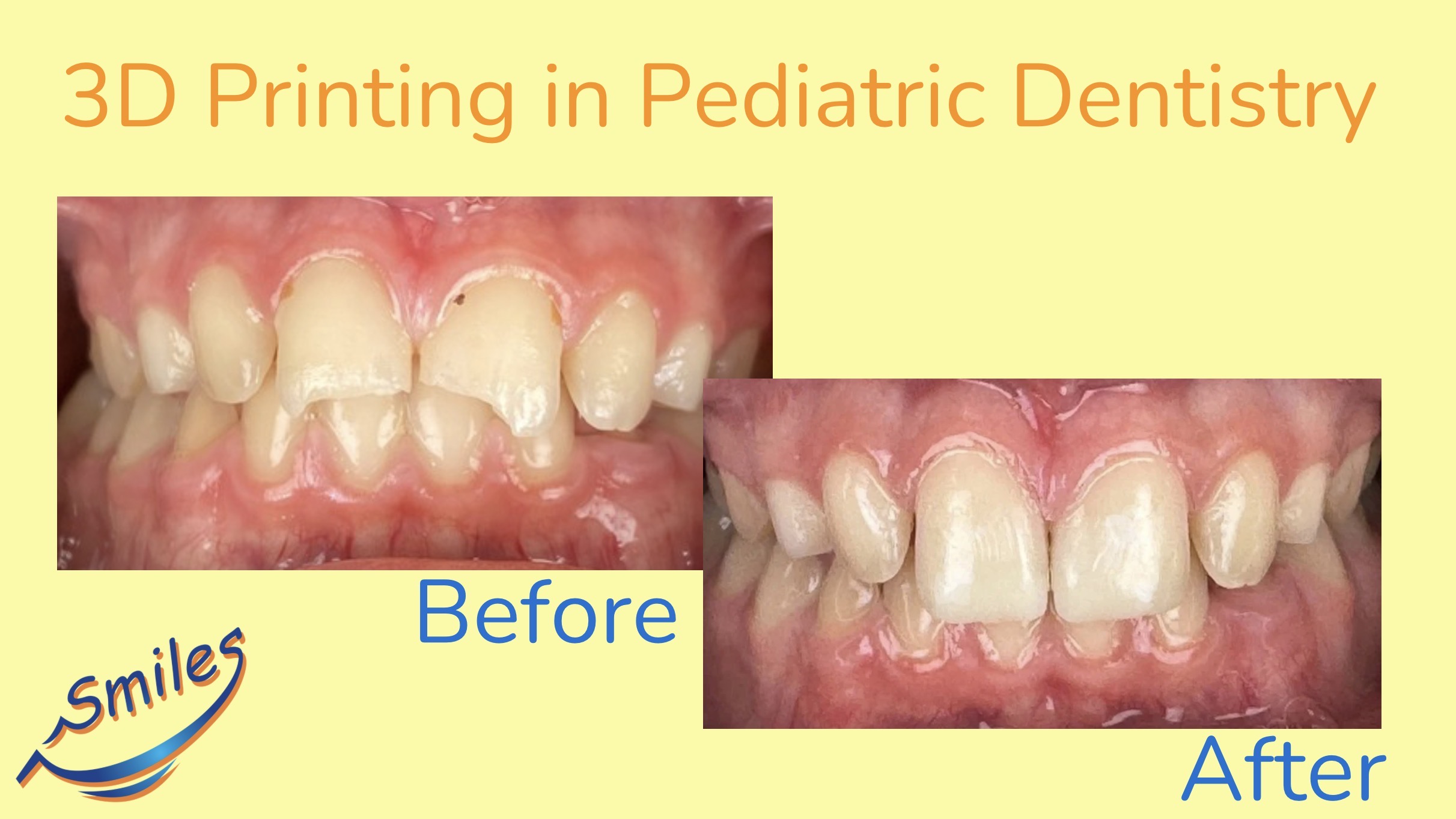 3D-printing-pediatric-dentistry-before-after-results-children