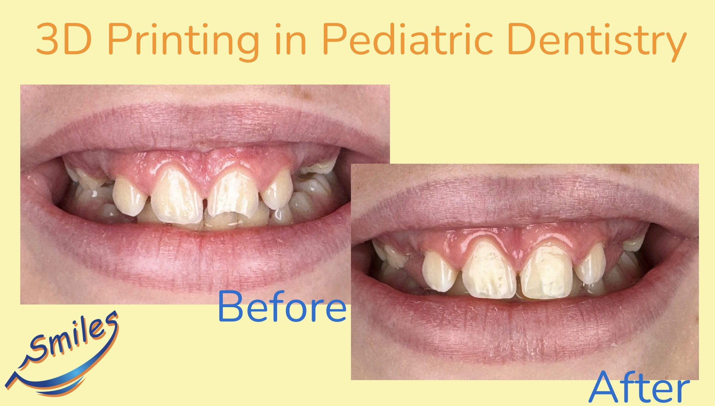 pediatric-dental-before-after-3d-printed-restoration-child