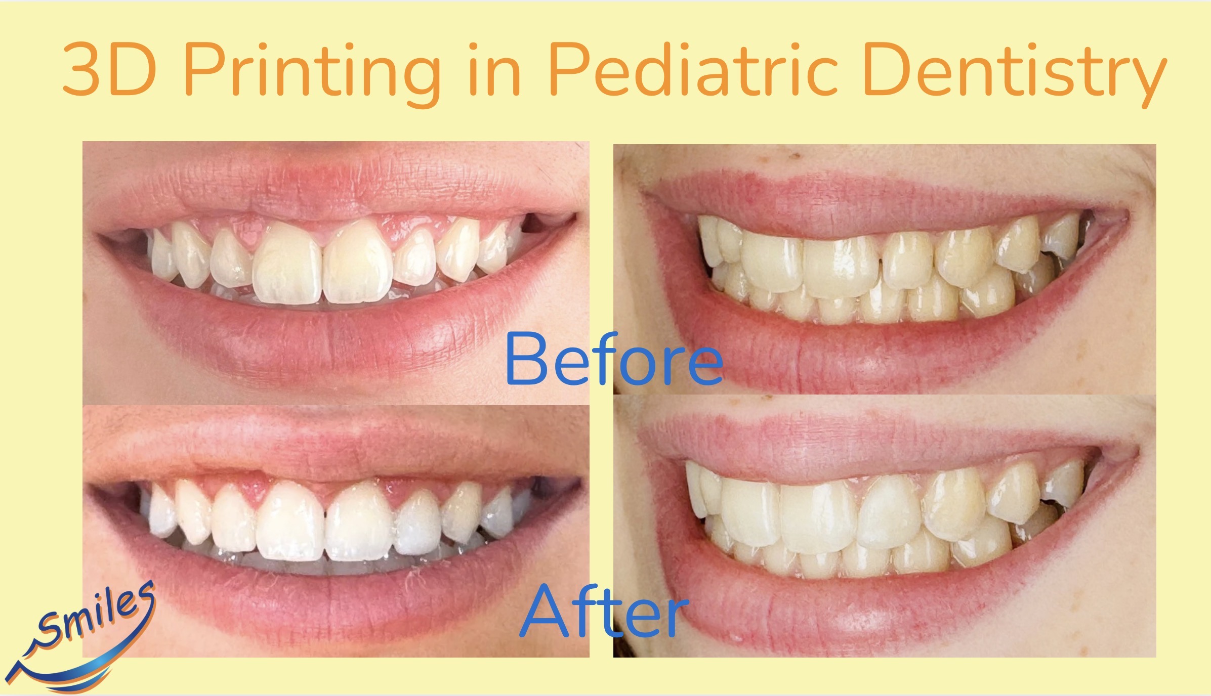 pediatric-dentistry-before-after-smile-restoration-child