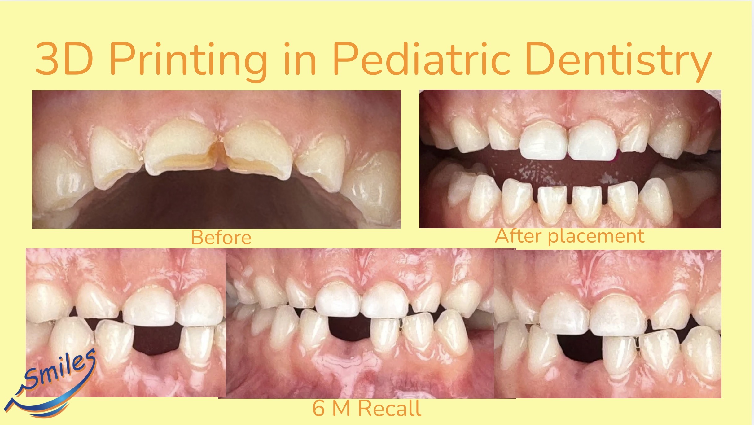 pediatric-3d-printing-dentistry-before-after-case-one