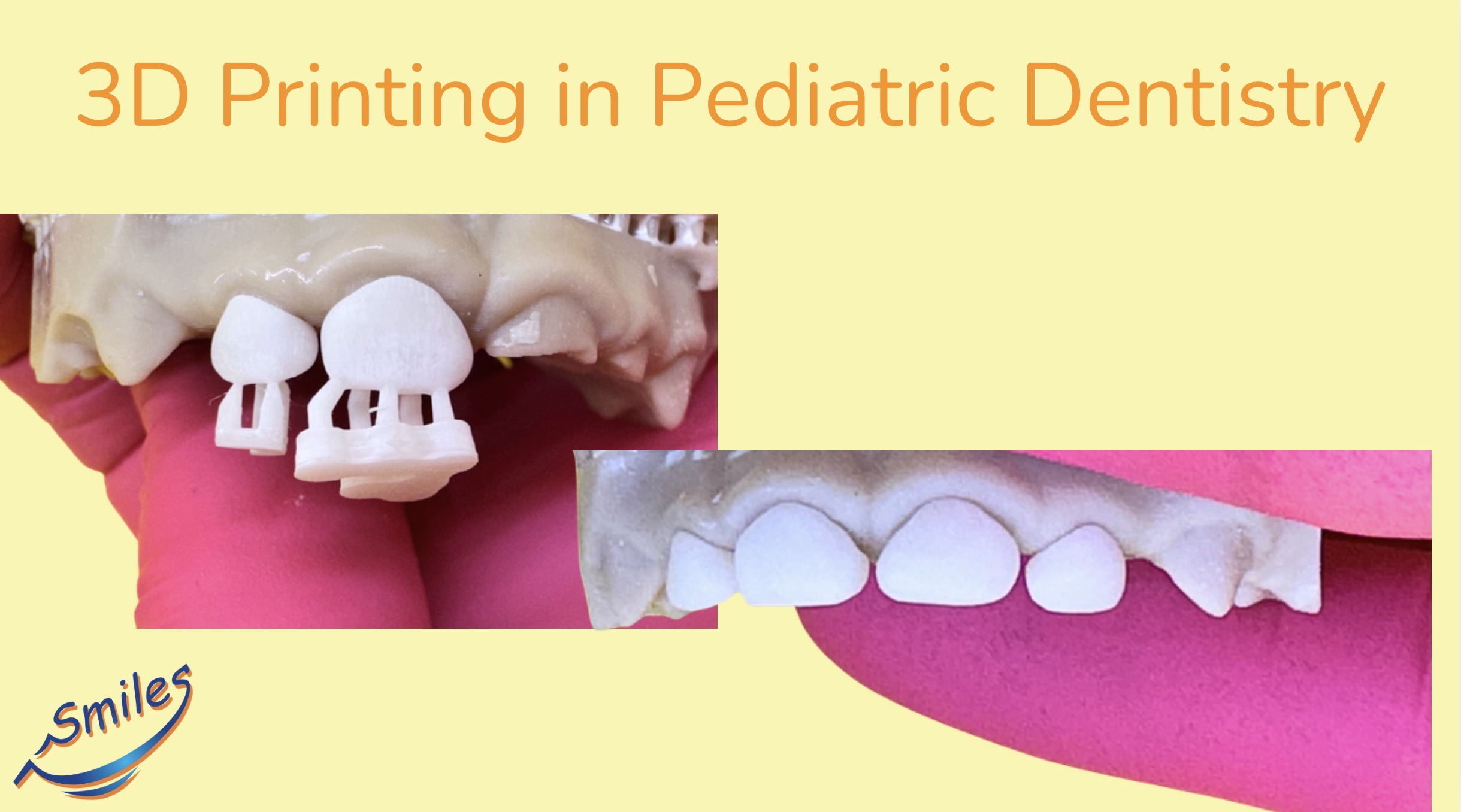 3D-printed-teeth-first-pediatric-3d-printed-dental-restoration-case
