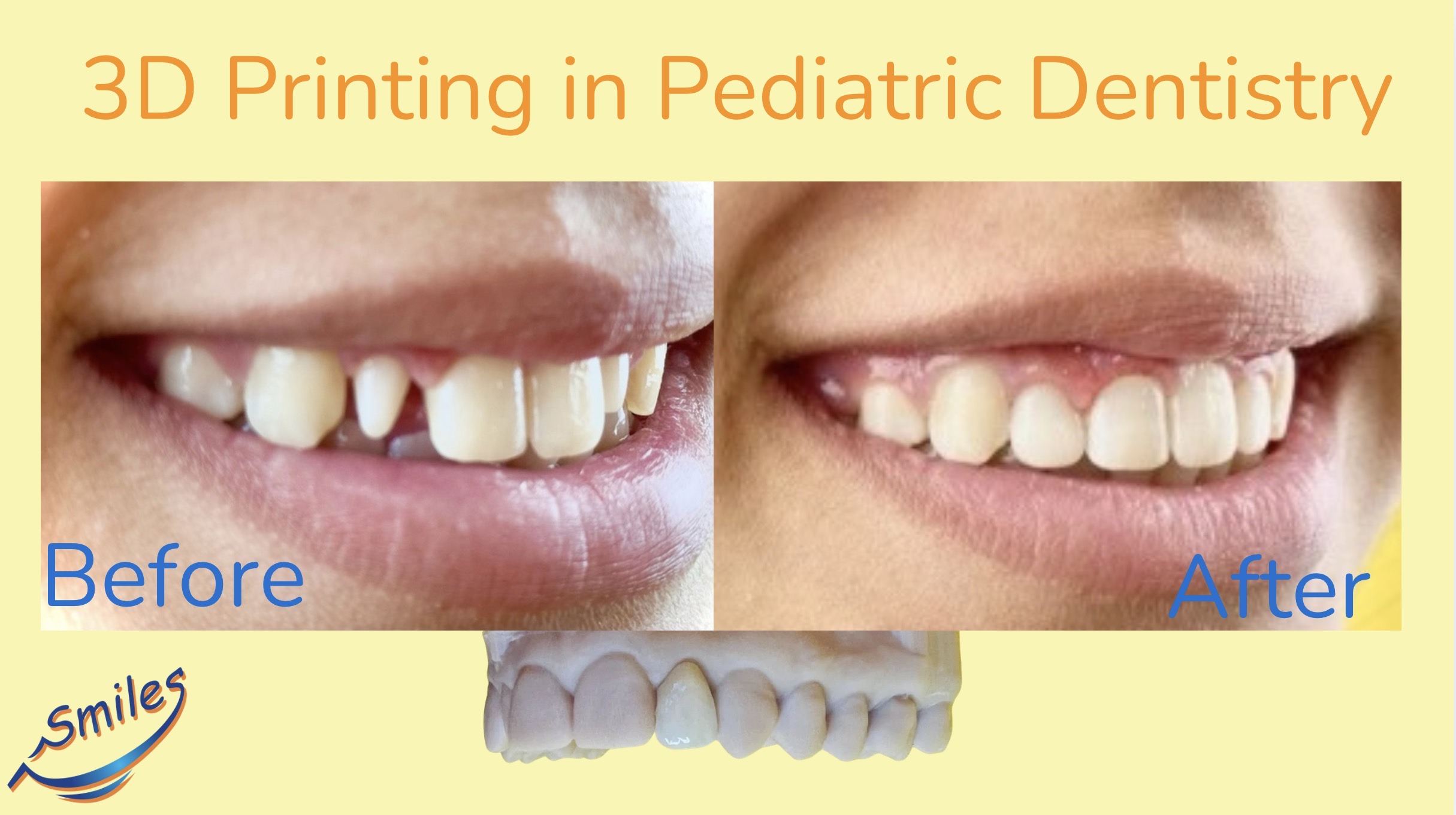 pediatric-dental-case-3d-printing-before-after