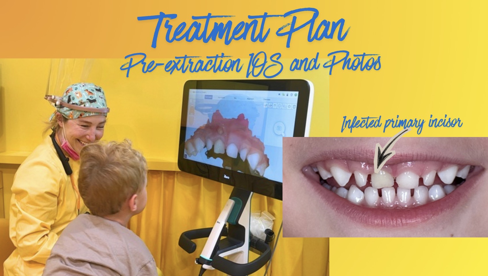 printismile-intraoral-scans-clinical-photos-primary-teeth