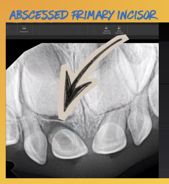 printismile-intraoral-scans-clinical-photos-primary-teeth