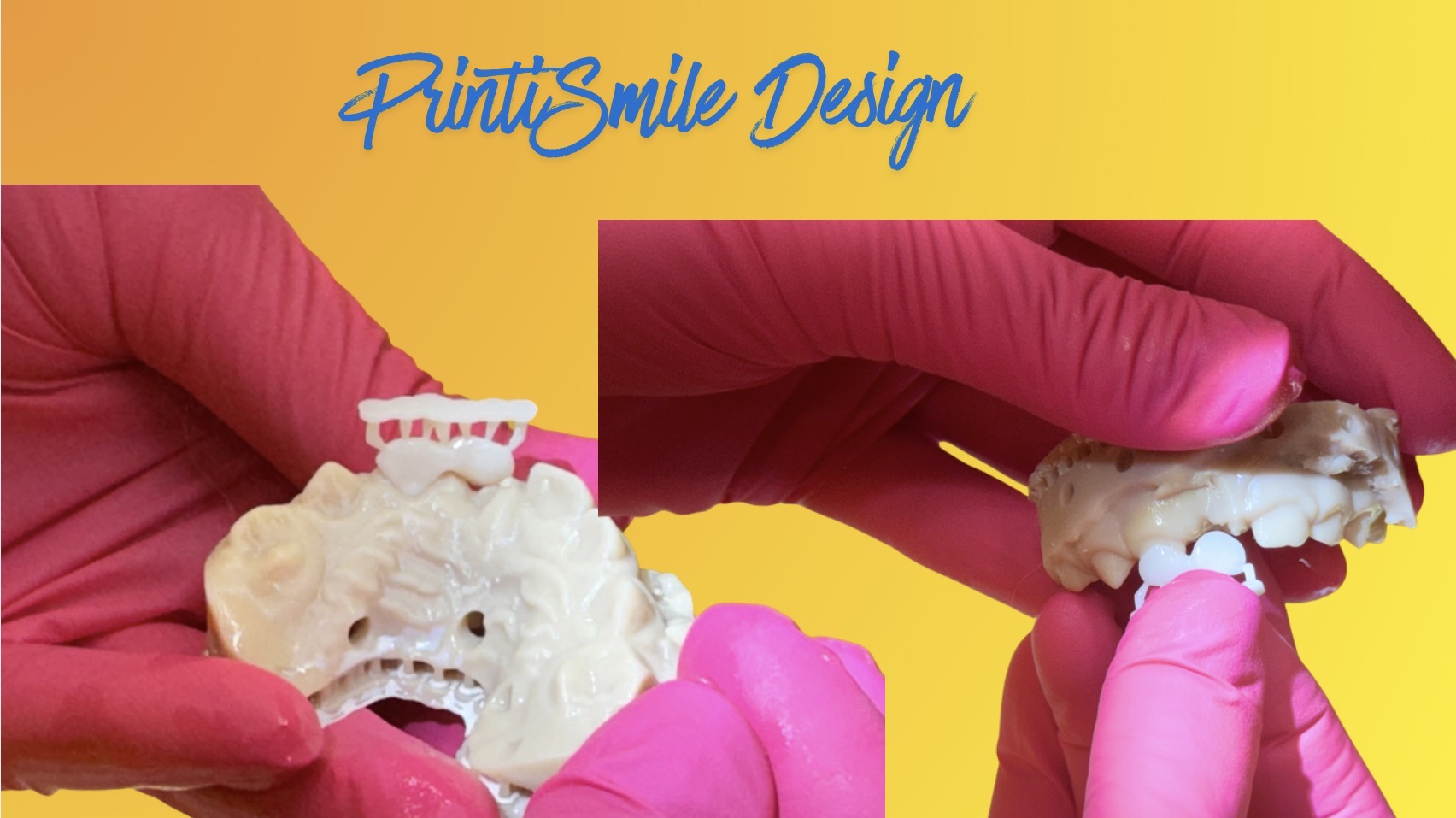 Introducing PrintiSmile™: A Gentle, 3D-Printed Solution for Missing Baby Front Teeth