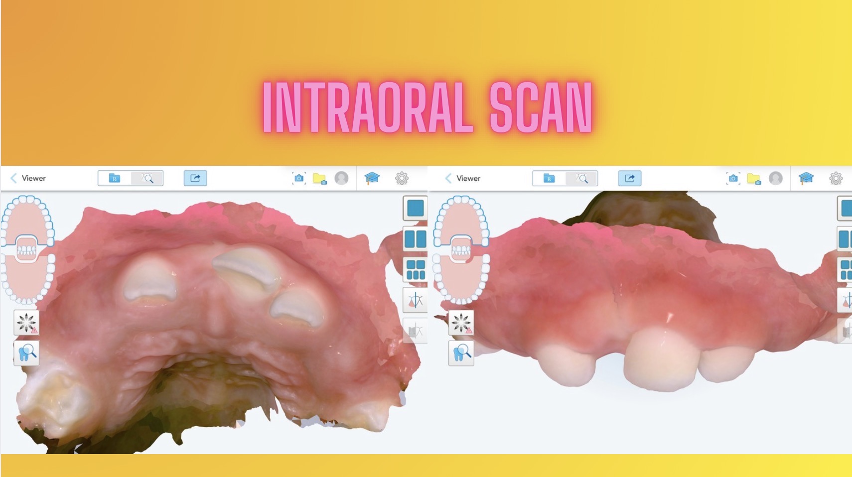 printismile-intraoral-scans-clinical-photos-primary-teeth
