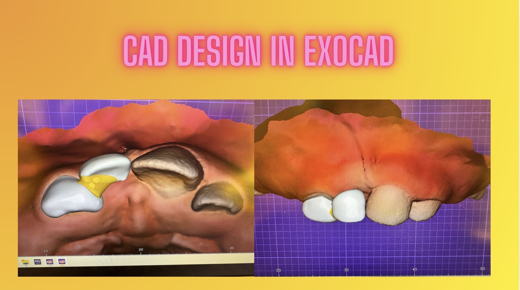 printismile-intraoral-scans-clinical-photos-primary-teeth