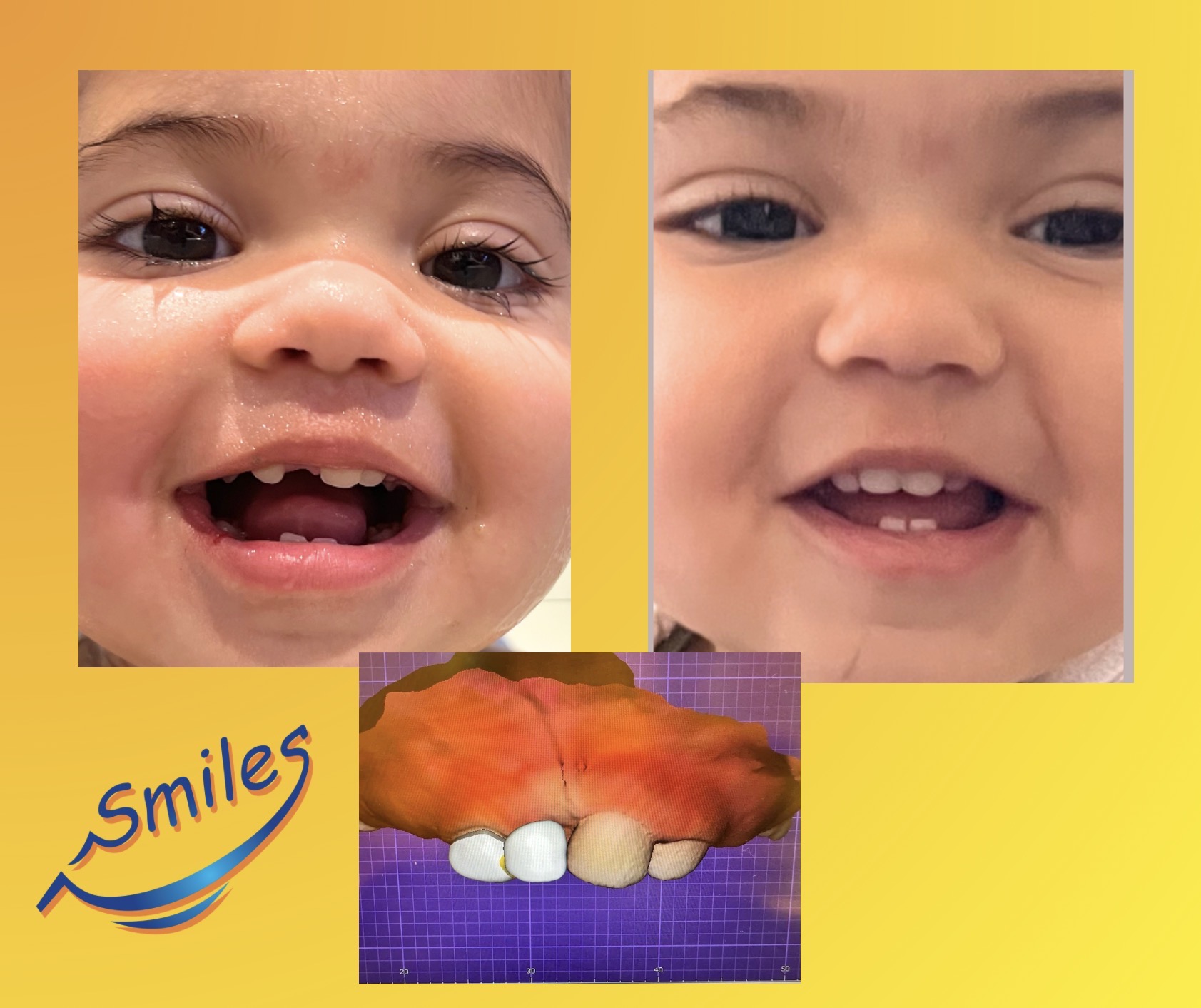 printismile-intraoral-scans-clinical-photos-primary-teeth